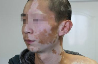 武汉白癜风对男性身体有什么危害呢?